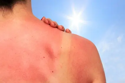 Sonnenschutz Sonnenbrand